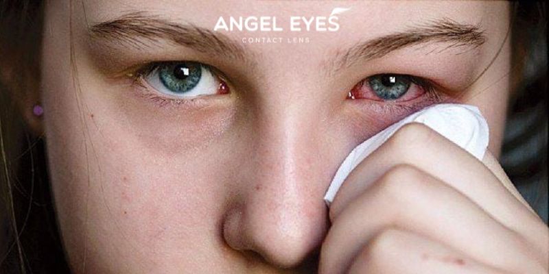 Cách xử lý an toàn khi Đeo Kính Áp Tròng Đi Ngủ