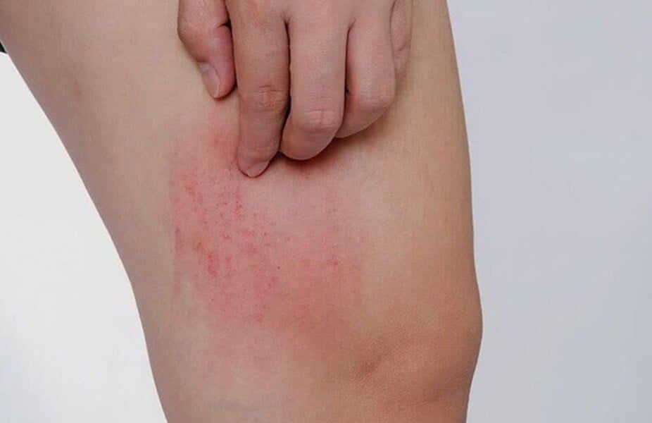 Vớ giãn tĩnh mạch là gì? Nguyên lý hoạt động và cách sử dụng hiệu quả