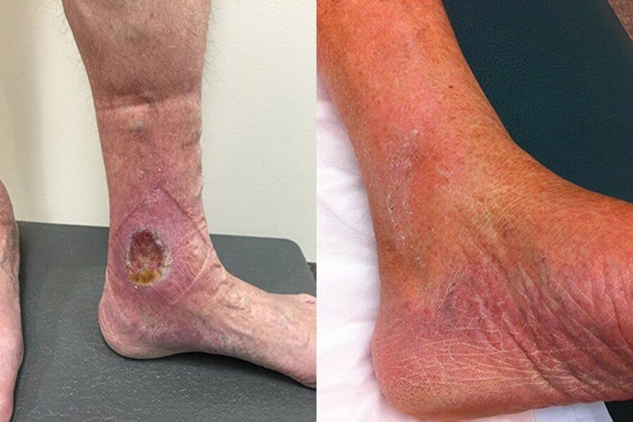 Vớ giãn tĩnh mạch là gì? Nguyên lý hoạt động và cách sử dụng hiệu quả