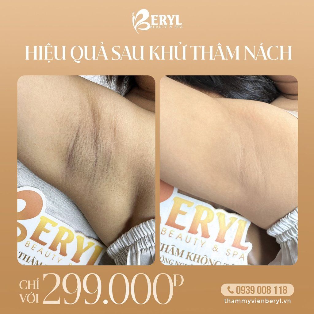 Trị thâm nách tại Beryl giá chỉ 299k