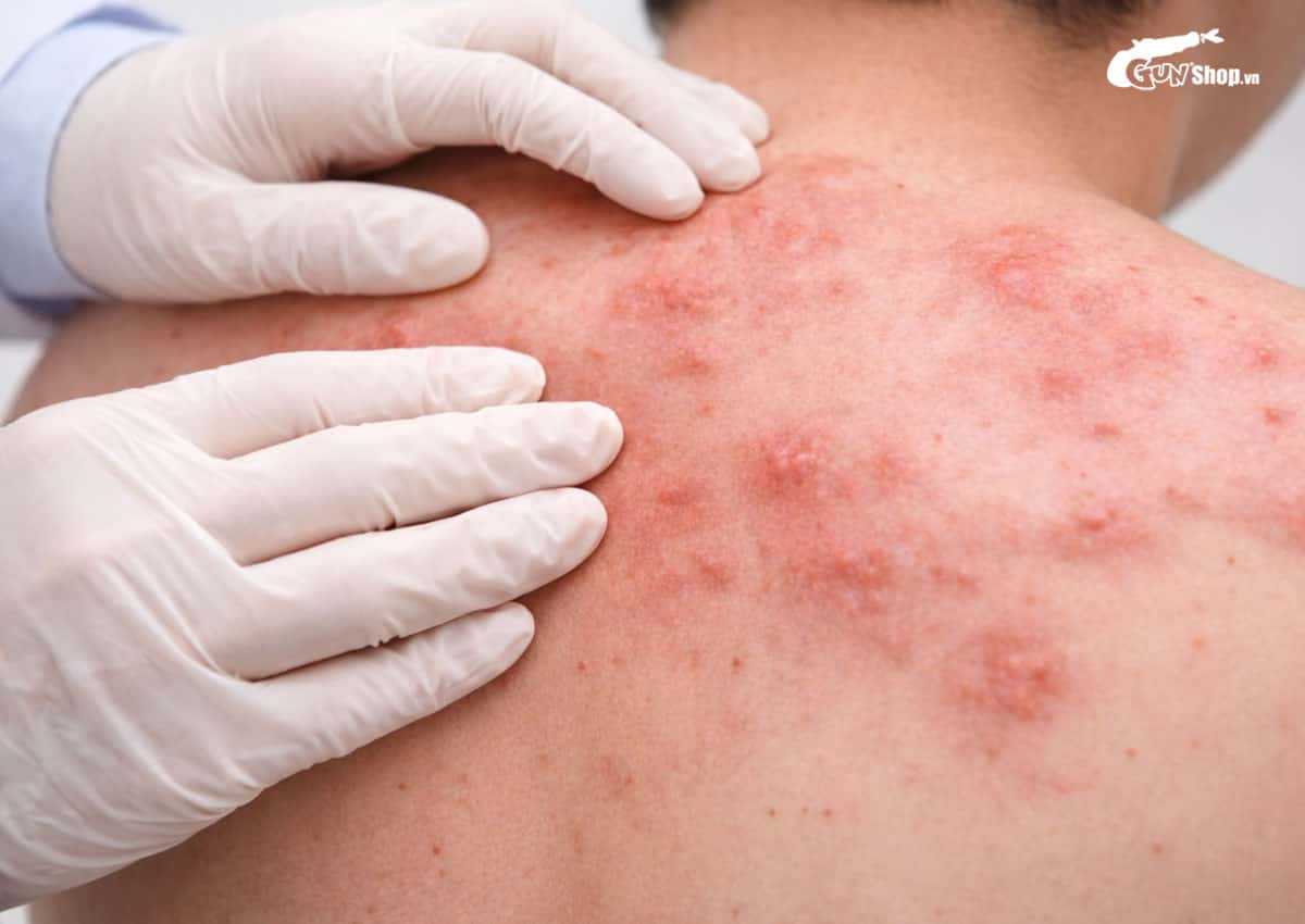 Bị giang mai có quan hệ được không?