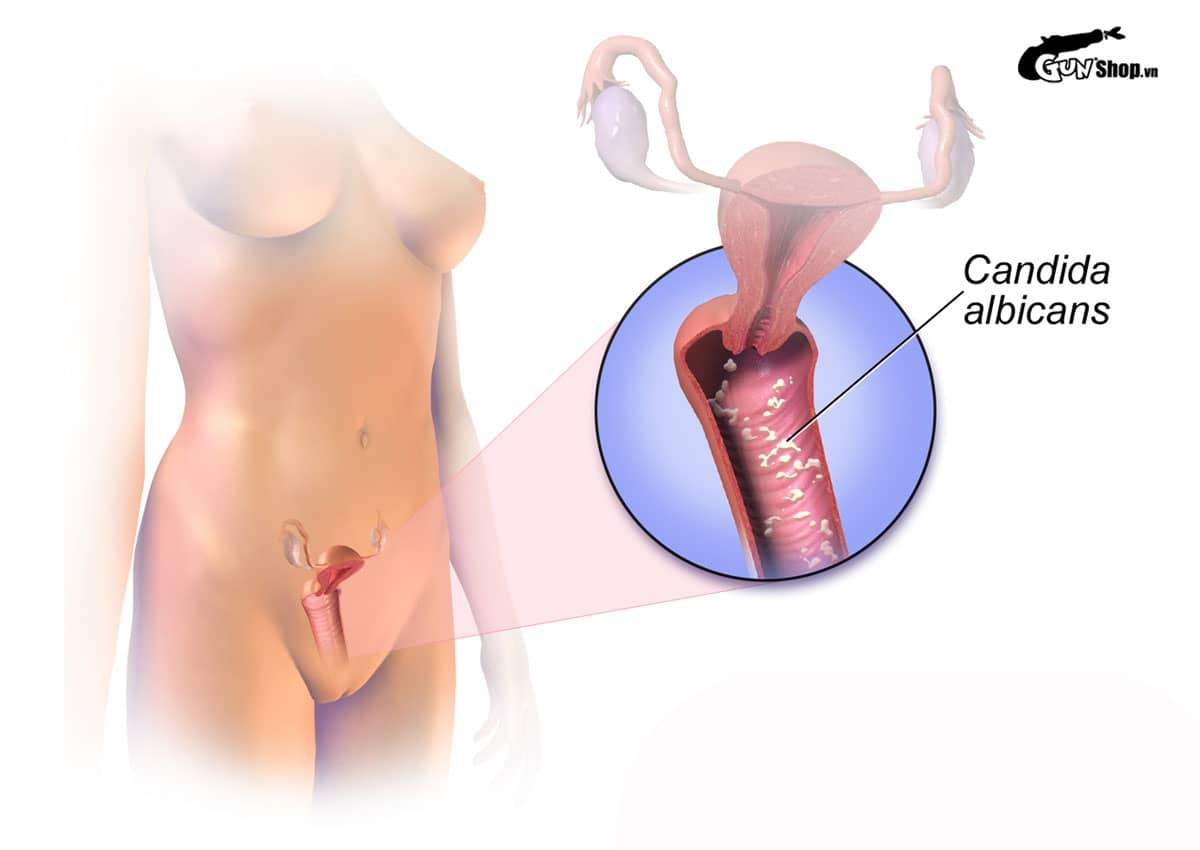 Chưa quan hệ có bị nấm không?