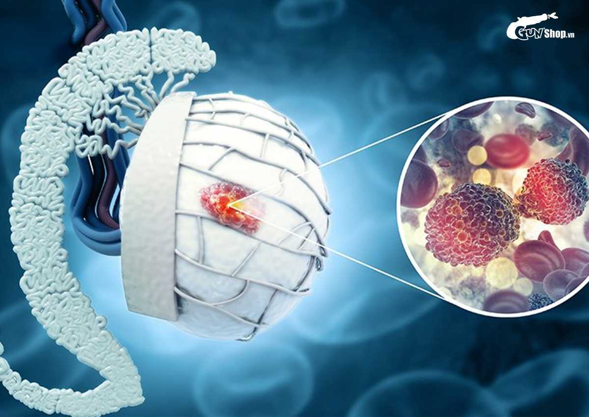 Đặt tinh hoàn nhân tạo là gì?