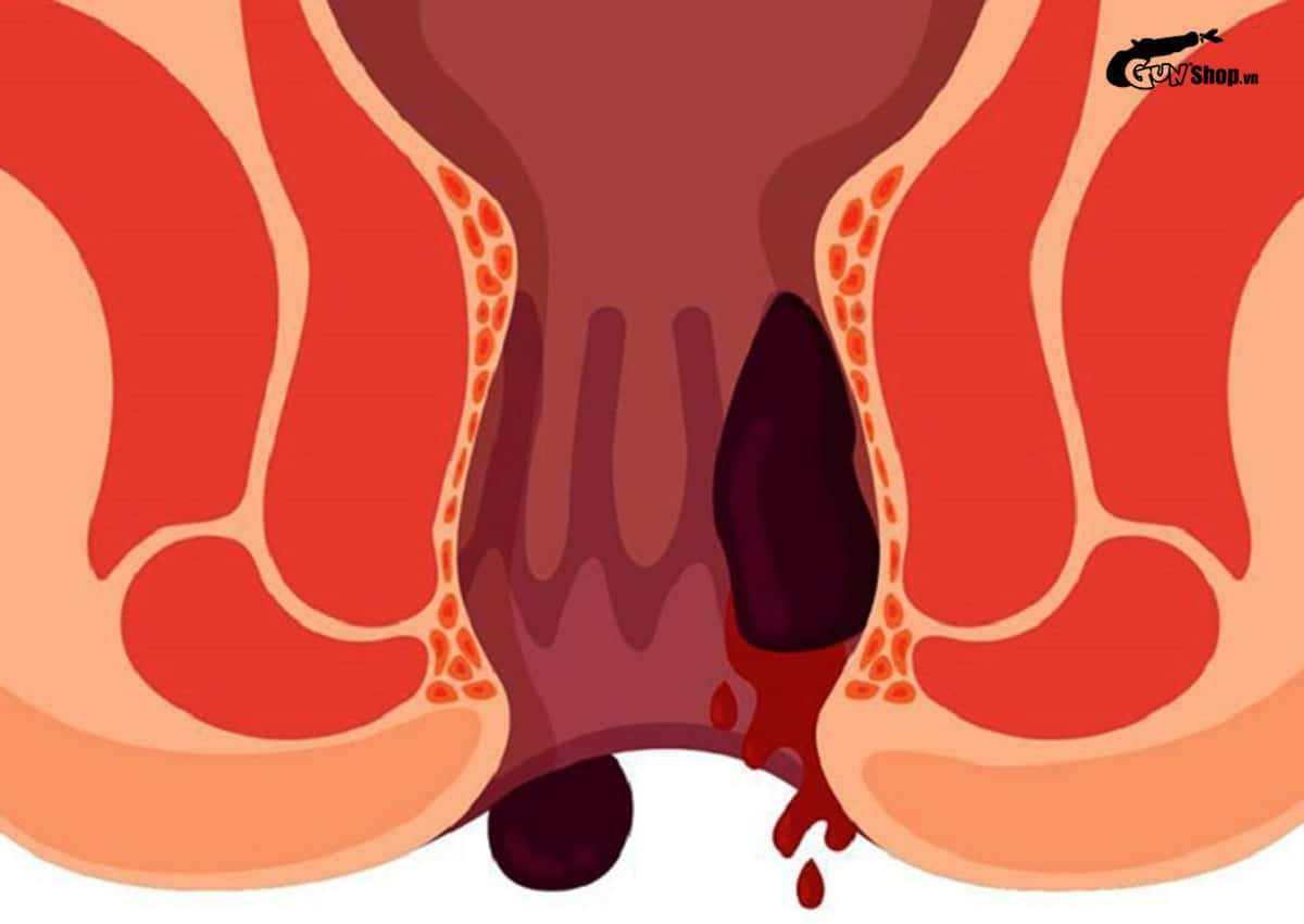 Sau mổ trĩ kiêng quan hệ bao lâu?