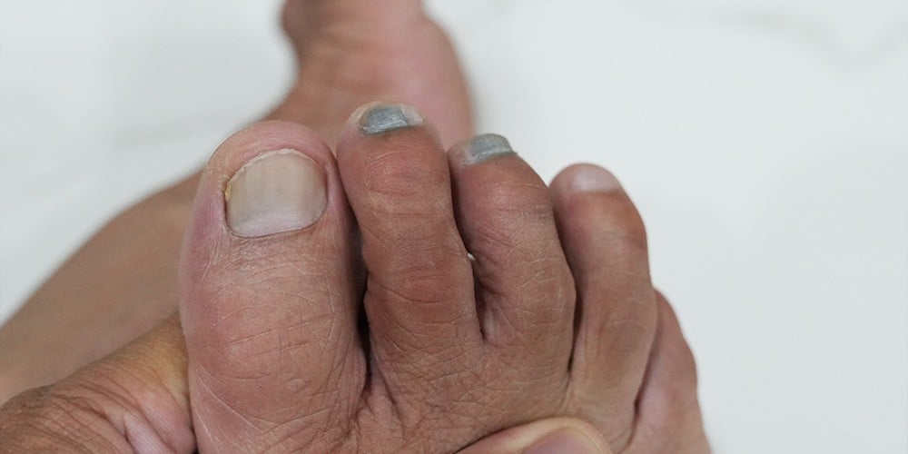 BẦM TÍM NGÓN CHÂN KHI ĐÁ BÓNG: NGUYÊN NHÂN VÀ CÁCH KHẮC PHỤC TRIỆT ĐỂ