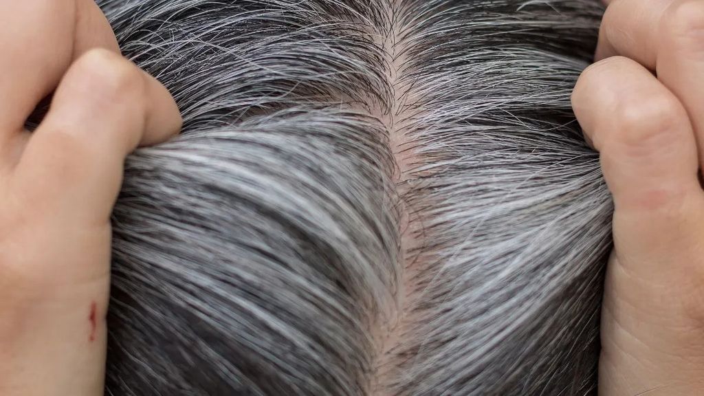 Nang tóc bị tổn thương khiến tóc chuyển bạc