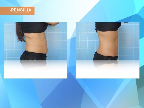 cach-giam-mo-bung-duoi-truoc-sau