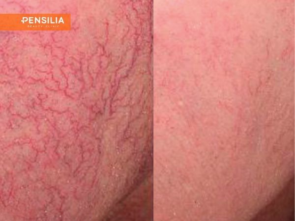 gian-mao-mach-o-mat-truoc-sau