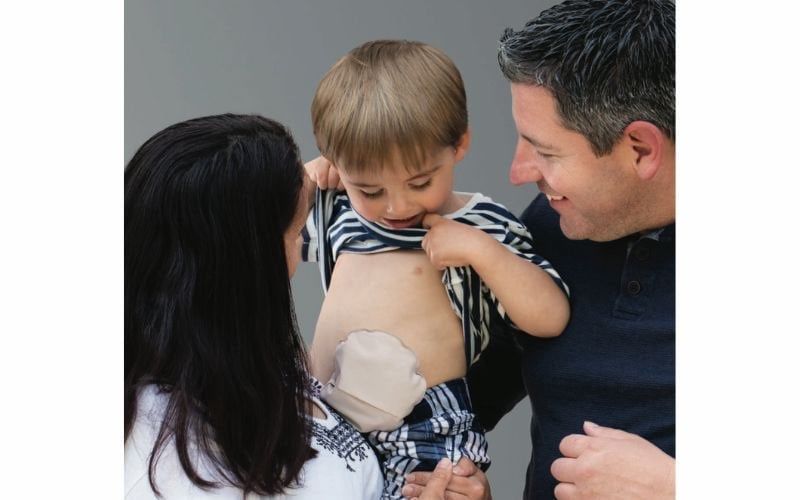 Hậu môn nhân tạo cho trẻ em