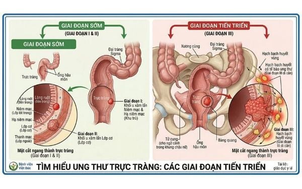 Ung thư trực tràng giai đoạn 3