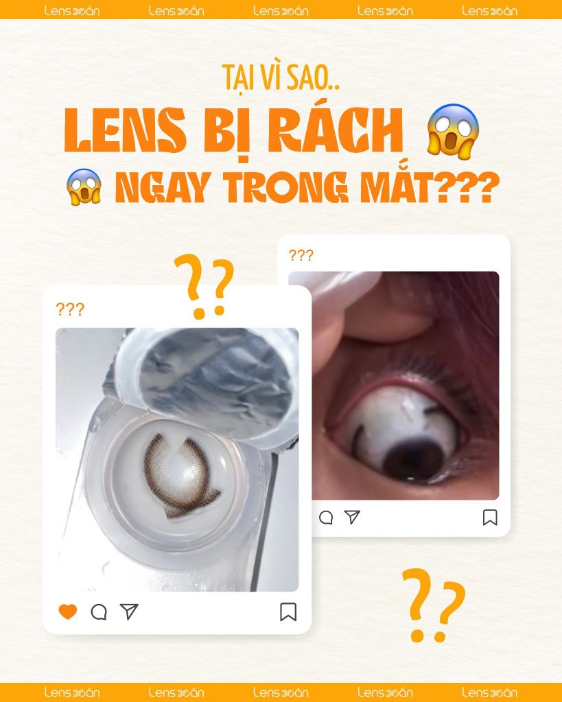 Lens bị rách ngay trong mắt và cách phòng tránh an toàn