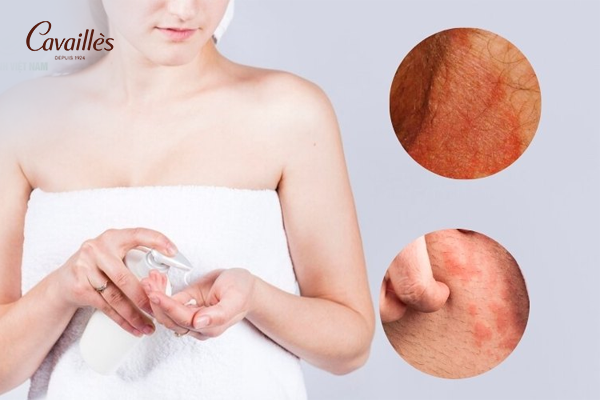 Tiêu chí chọn dung dịch vệ sinh phụ nữ trị viêm ngứa