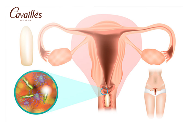 Nguyên nhân viêm âm đạo