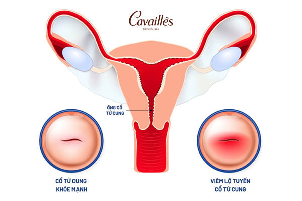Viêm lộ tuyến cổ tử cung là gì?