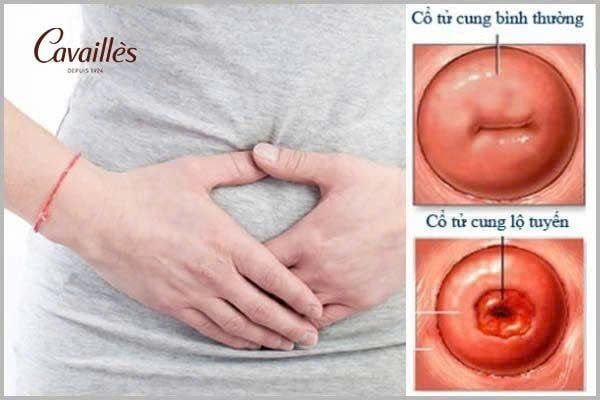 Triệu chứng viêm lộ tuyến cổ tử cung