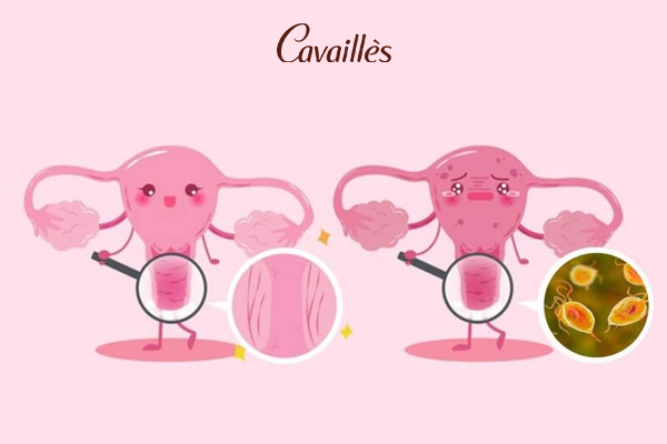 Dung dịch vệ sinh có chữa Trichomonas không?