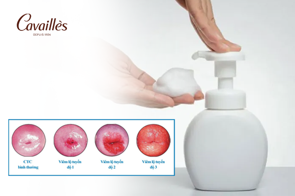 Hướng dẫn sử dụng dung dịch vệ sinh theo từng cấp độ viêm