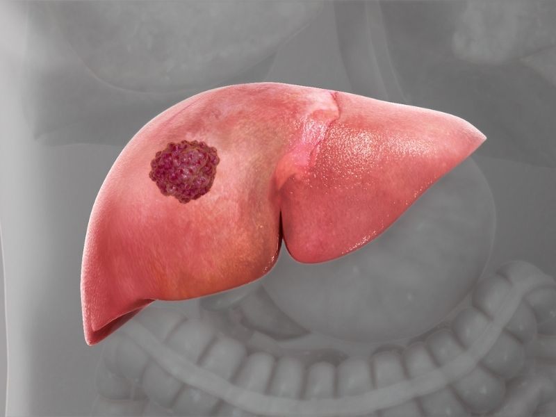 ruou-bia-gay-ung-thu-gan