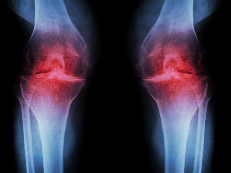 tac-hai-cua-ruou-bia-den-xuong-khop