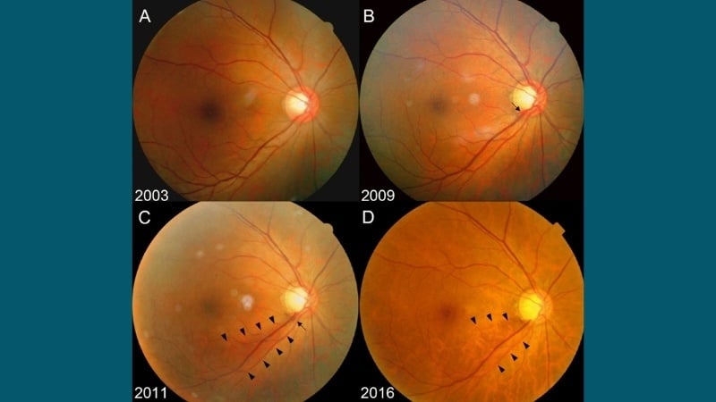 Dấu hiệu tổn thương thần kinh thị giác trong glaucoma với lõm gai rộng bất thường.
