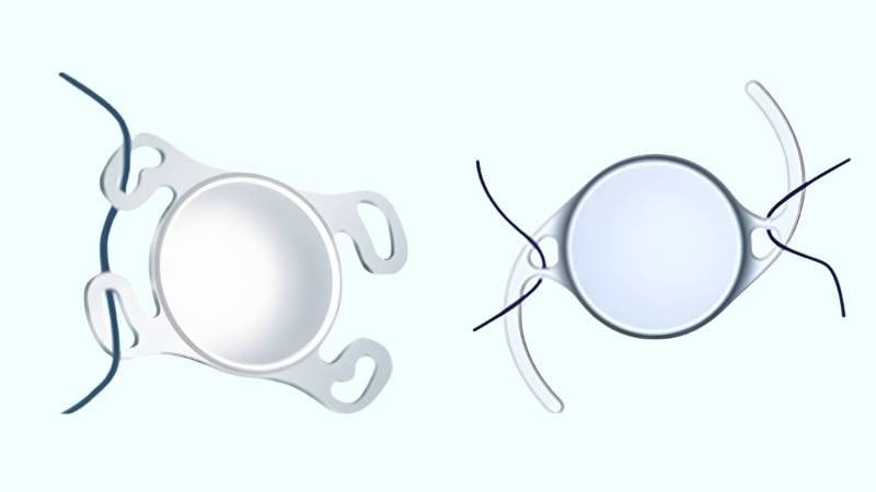 Phẫu thuật treo củng mạc là một trong những kỹ thuật đòi hỏi phải có tay nghề rất cao