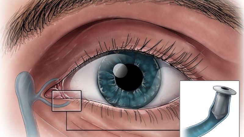 Cơ chế hoạt động của nút điểm lệ