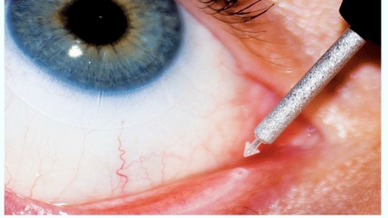 Quá trình cấy nút điểm lệ này chỉ mất vài giây cho mỗi mắt và bệnh nhân