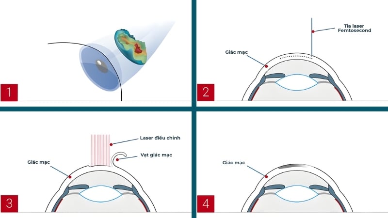 Quy trình phẫu thuật Femto Lasik tại Hai Yen Eye Care