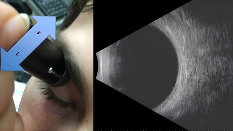 Bác sĩ di chuyển đầu dò siêu âm theo nhiều hướng để tạo hình ảnh chi tiết bên trong mắt.