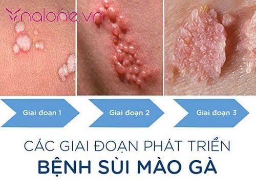 Ngủ chung có lây sùi mào gà không?