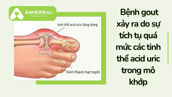 bệnh gout xảy ra là do tích tụ quá mức axit uric