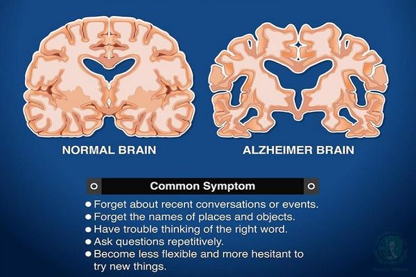 nguyên nhân bệnh Alzheimer ở người trẻ tuổi
