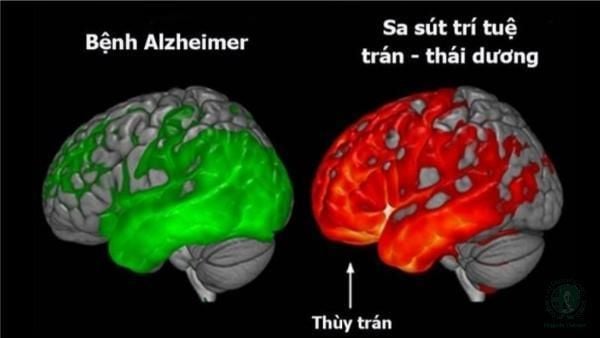 cách phân biệt sa sút trí tuệ và bệnh Alzheimer