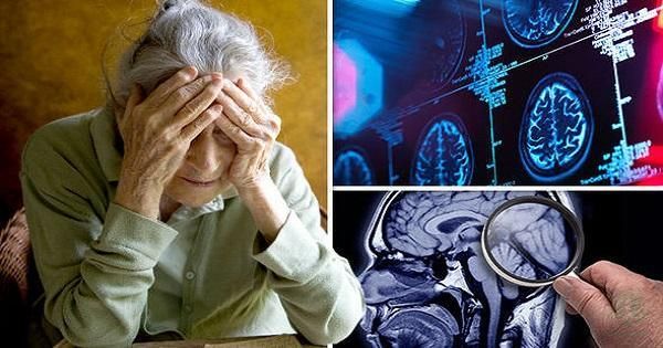 sự khác biệt sa sút trí tuệ và bệnh Alzheimer