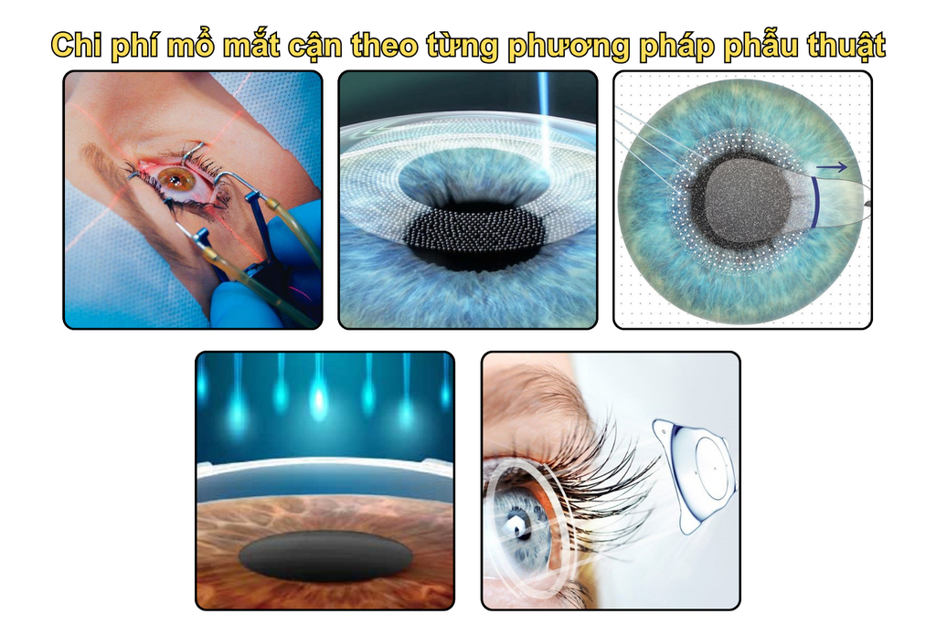 chi-phi-mo-mat-can-theo-tung-phuong-phap-phau-thuat