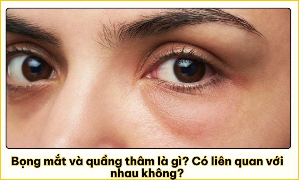 Phân biệt bọng mắt và quầng thâm