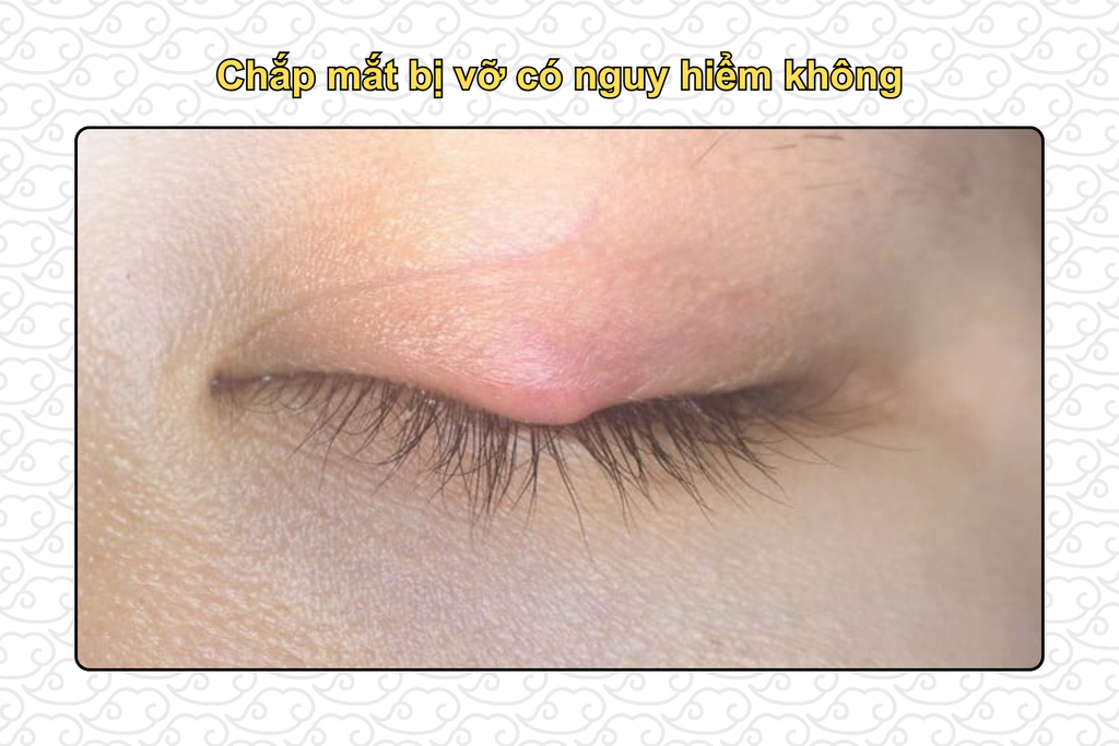 chap-mat-bi-vo-co-nguy-hiem-khong