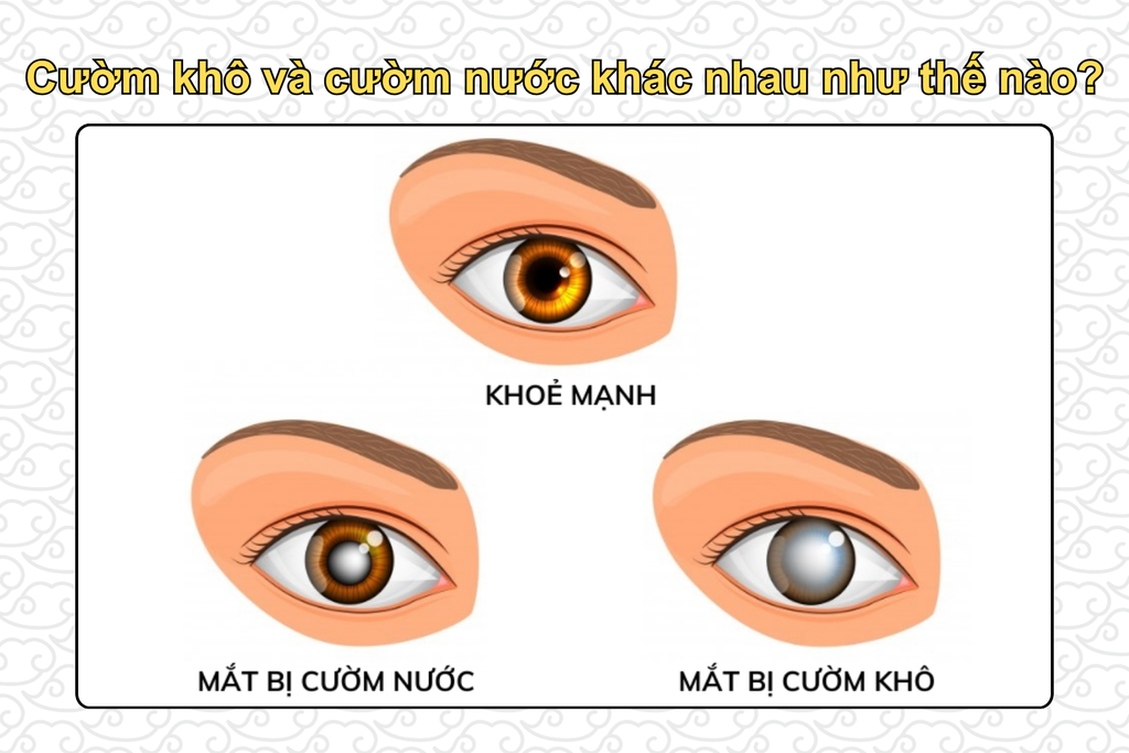 cuom-kho-va-cuom-nuoc-khac-nhau-nhu-the-nao