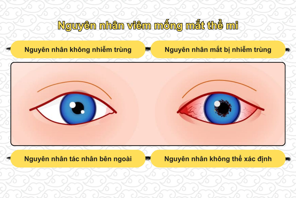 nguyen-nhan-viem-mong-mat-the-mi