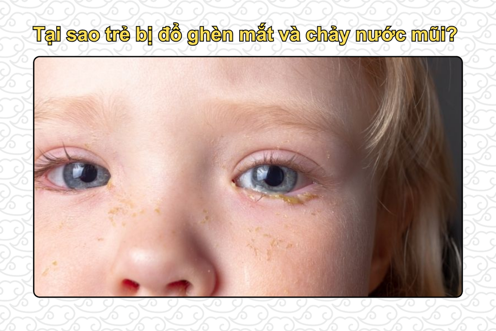 tai-sao-tre-bi-do-ghen-mat-va-chay-nuoc-mui