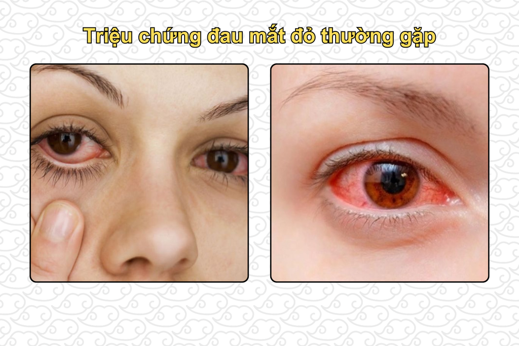 trieu-chung-dau-mat-do-thuong-gap