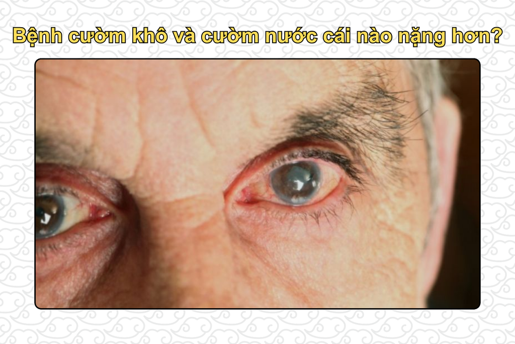 benh-cuom-kho-va-cuom-nuoc-cai-nao-nang-hon