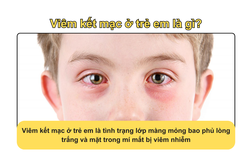 viem-ket-mac-o-tre-em-la-gi