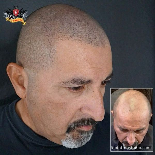 Kết quả xăm chân tóc trước và sau, giúp da đầu hói trở nên dày tóc tự nhiên hơn