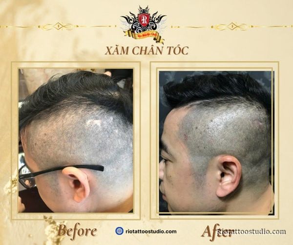 Hình ảnh trước và sau khi xăm chân tóc vùng đỉnh đầu, tóc trông dày và tự nhiên hơn rõ rệt