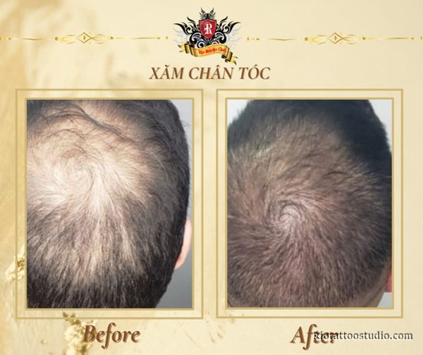 Hình ảnh trước và sau khi xăm chân tóc vùng đỉnh đầu, tóc trông dày và tự nhiên hơn rõ rệt
