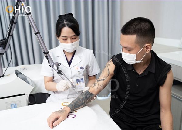 Xóa xăm tại Ohio