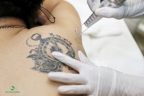 Xóa xăm tại Thu Cúc