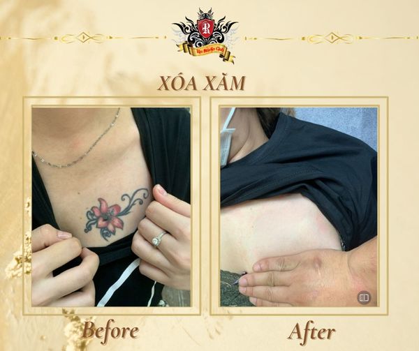 Xóa xăm tại Rio Tattoo Studio