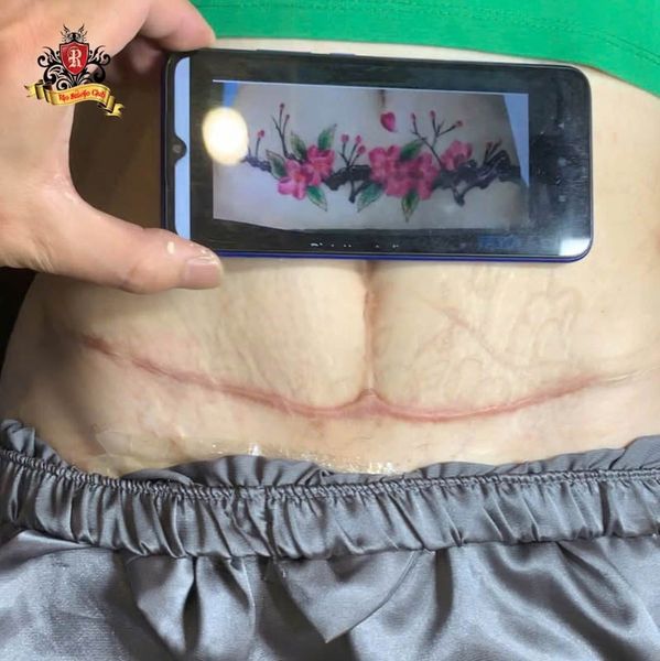 Xóa xăm tại Rio Tattoo Studio